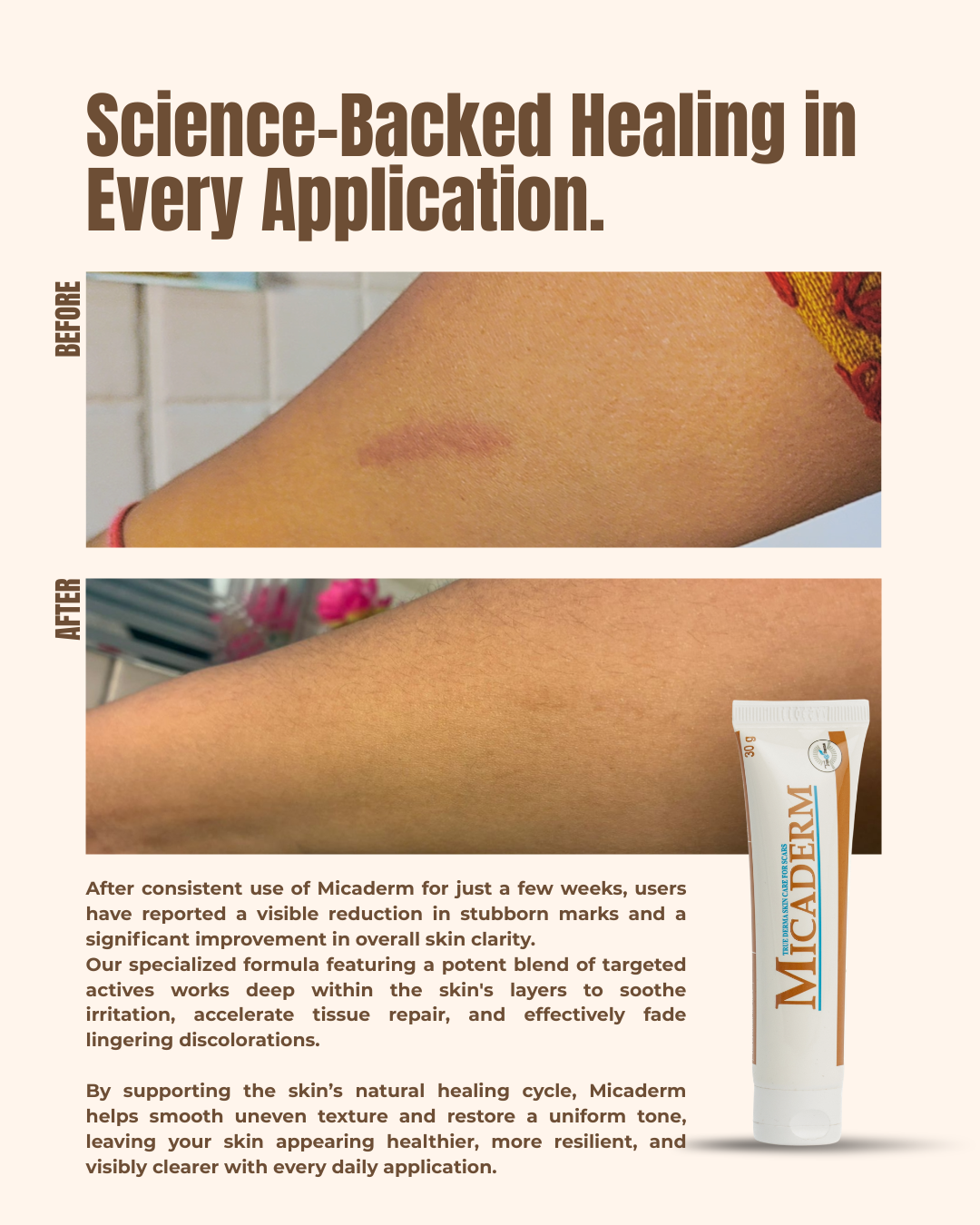 A side-by-side comparison showing a visible reduction in skin marks and improved texture after 2 weeks of using Micaderm skin repair cream. The image features a clinical luxury aesthetic and the Micaderm product tube.