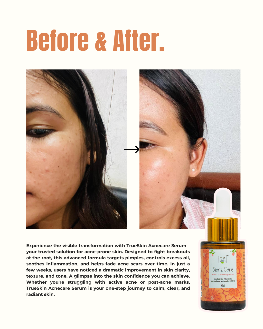 Before and after comparison of a woman’s face showing clear skin results after using True Skin Acnecare Serum for acne and pimples.