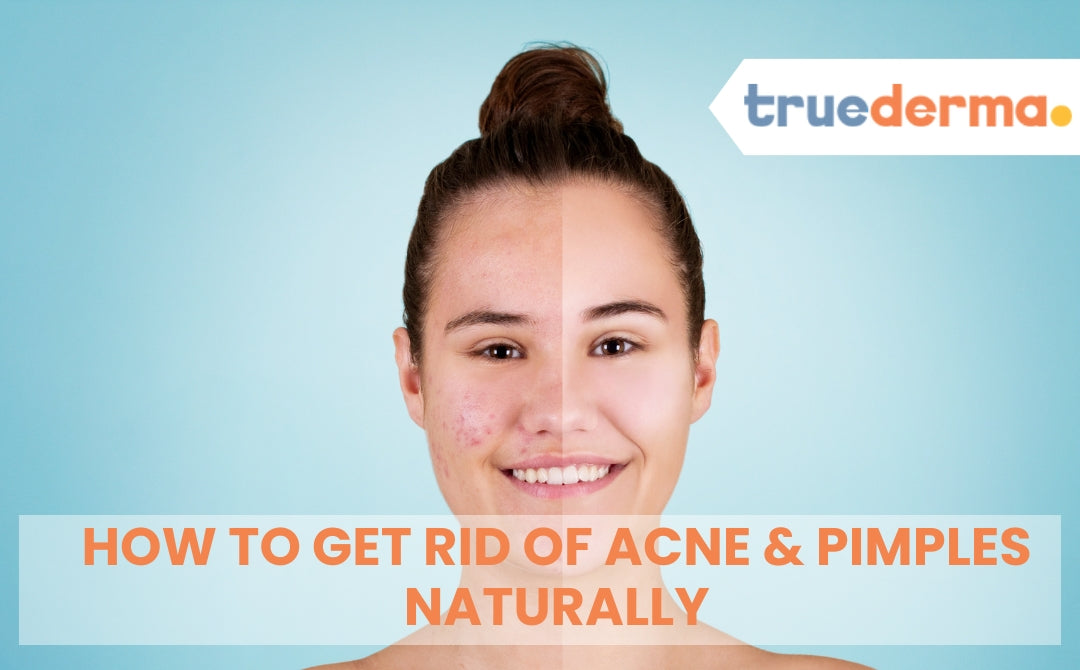 How to Get Rid of Acne & Pimples Naturally: A Complete Guide