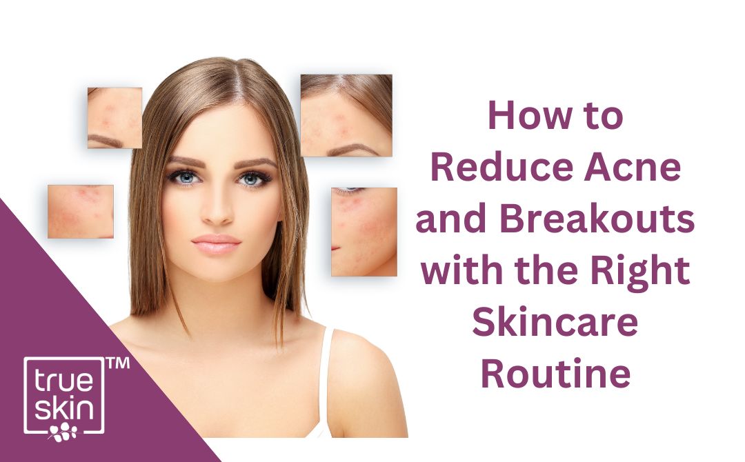 How to Reduce Acne and Breakouts with the Right Skincare Routine